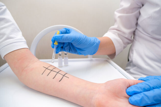 测试做皮肤点刺过敏的免疫学家试验.发红手臂脱皮分析过敏移液管